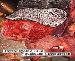 Download Biliary Cirrhosis - Intrahepatic Bile Ductules Obstruction